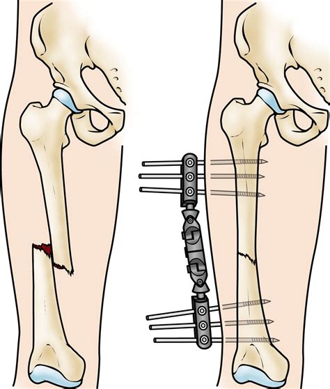 Internal Fixation for Fractures - OrthoInfo - AAOS