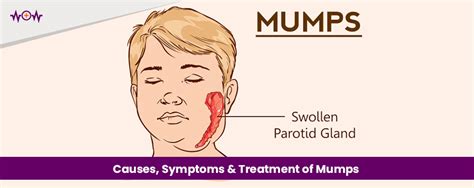 Causes, Symptoms & Treatment of Mumps - WoW Health Pakistan