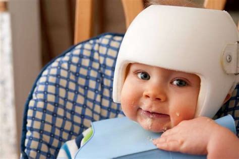 Flat Head Syndrome (positional Plagiocephaly And Brachycephaly ...