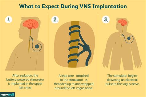 Vagus Nerve Stimulation Side Effects