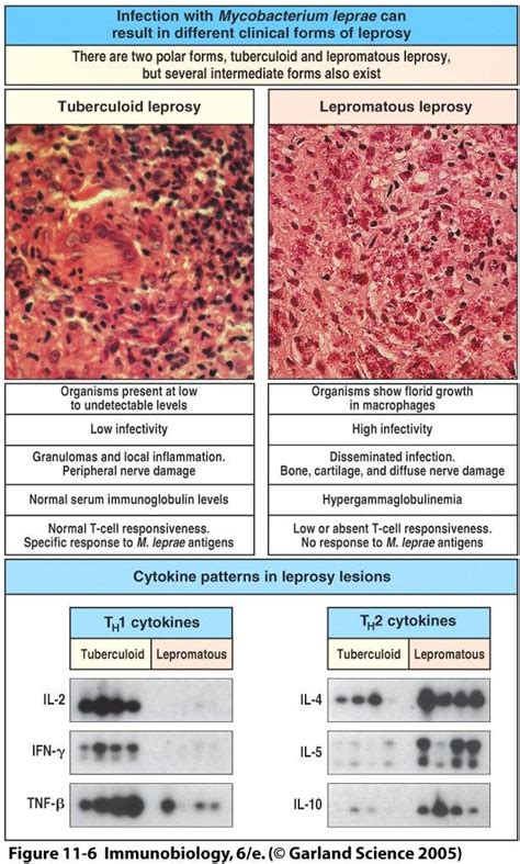 Tuberculoid Leprosy Symptoms