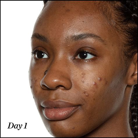 ACNE 101 – Sunday Riley