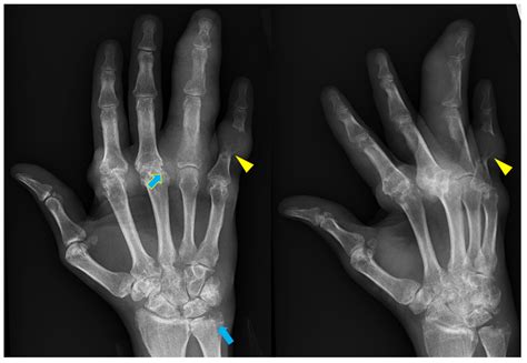 Rheumatoid Arthritis X Ray