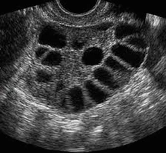 ultra(Sound) Bites: PCOS | RMA Network - Fertility Clinic