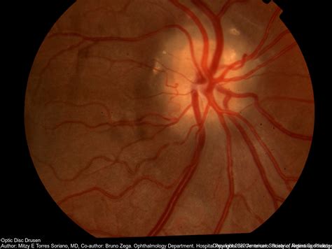 What Is the Optic Disc? - Medical Definition