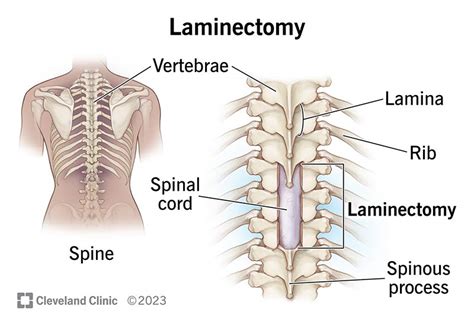 Laminectomy: What It Is, Procedure, Recovery & Complications