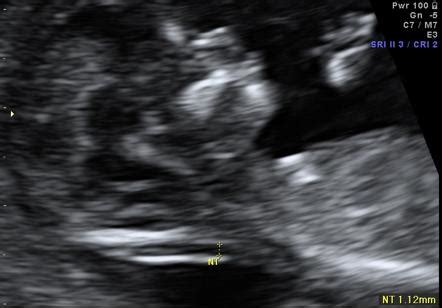 Abnormal Nuchal Translucency Normal Baby - expeditionwoman