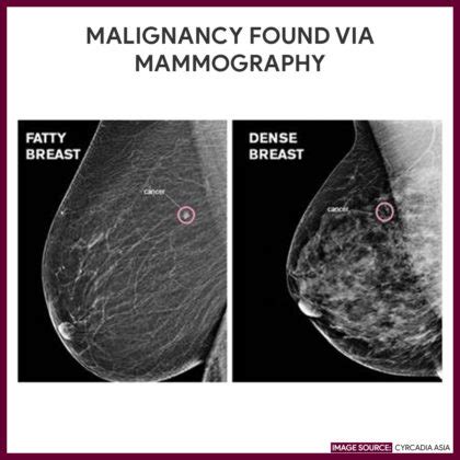 Mammography (Mammogram) - Nursing Responsibilities - Nurseslabs