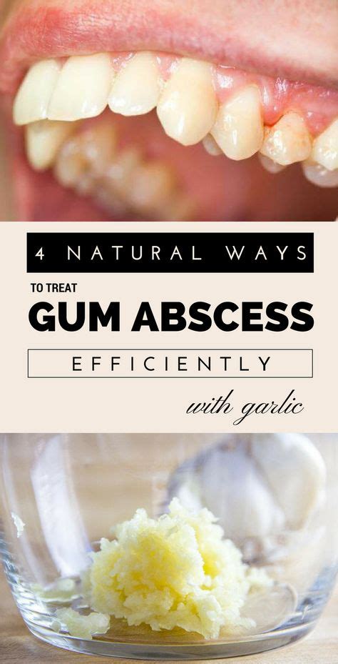 4 Natural Ways To Treat Gum Abscess Efficiently With Garlic in 2020 ...