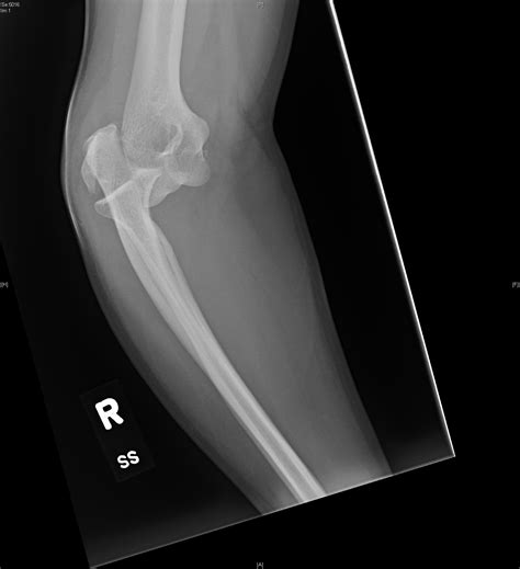 Lateral Epicondyle Fracture, Right Elbow Lateral XR. JETem 2018 - JETem