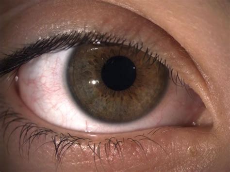 Hippus phenomenon คือ dilating and contracting pupillary movements ...