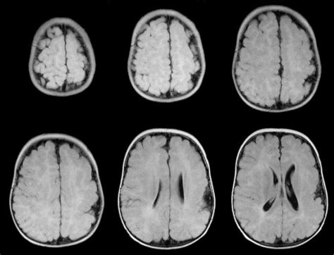 Lissencephaly