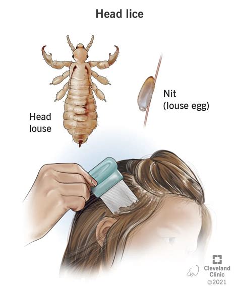 Signs of lice, symptoms, causes and treatment (2022)