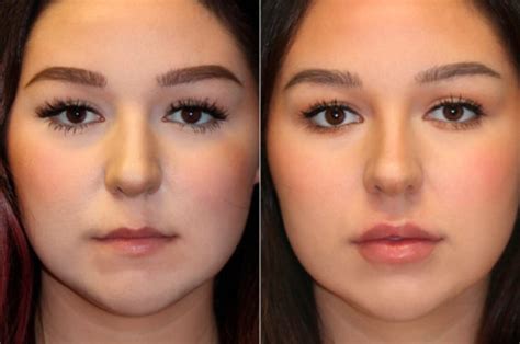 Lip Augmentation photos | Chevy Chase, MD | Patient 15105