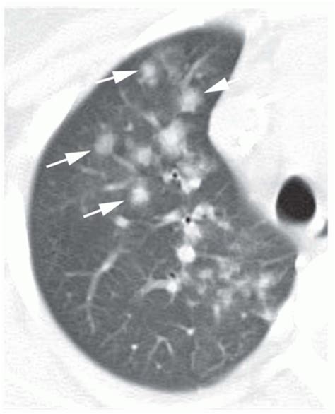 Diffuse Pulmonary Hemorrhage and Pulmonary Vasculitis | Radiology Key