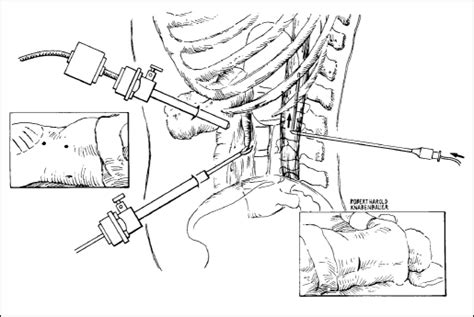 Patient positioning for laparoscopy-assisted lumboperitoneal shunt ...