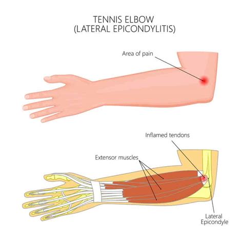 Elbow Conditions | Elbow Injuries | FORM Hand, Wrist & Elbow Institute