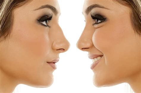 Liquid Nose Jobs Or Non-surgical Rhinoplasty - MIRA Clinic