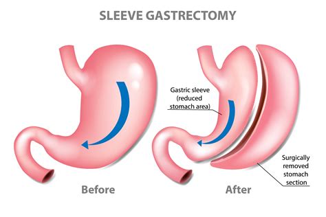 The honest truth about gastric sleeve surgery | Nashville Weight Loss ...