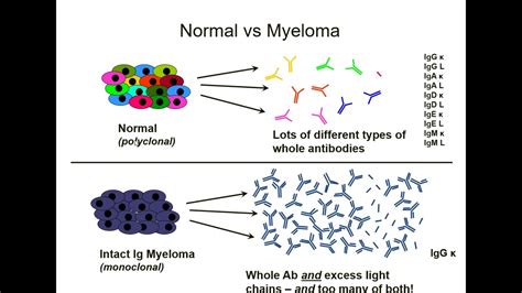 Does High Kappa Light Chain Mean Myeloma | Americanwarmoms.org