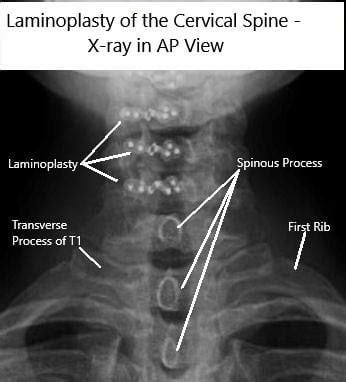 Cervical Laminoplasty: A Novel Surgery | Complete Orthopedics ...