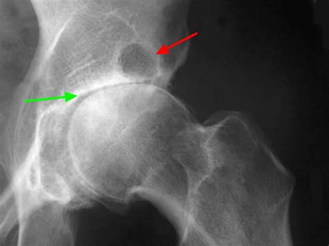 Osteoarthritis - Causes, Symptoms, Diagnosis, Prognosis & Treatment