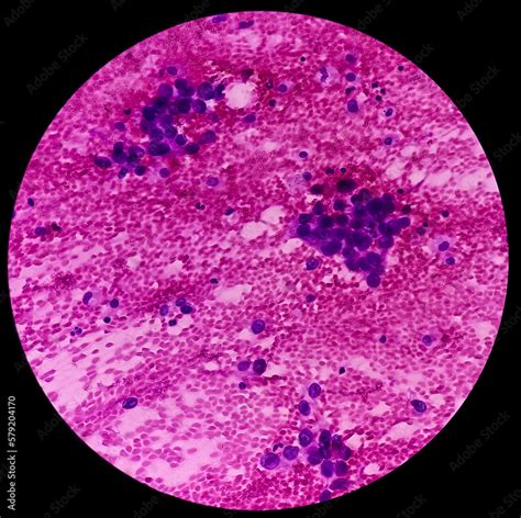 Lungs adenocarcinoma. Malignant cell. Smear show cellular material of ...