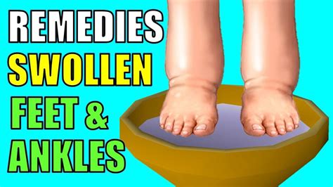 5 Effective Natural Remedies for Swollen Feet and Ankles (EDEMA) - YouTube