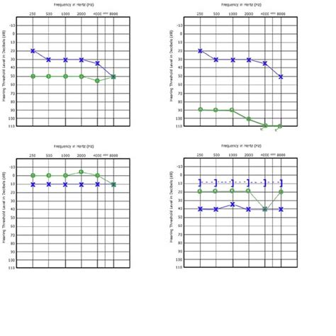 How to Read an Audiogram: The Basics