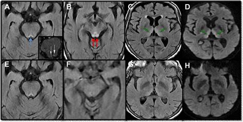 Cureus | Wernicke’s Encephalopathy