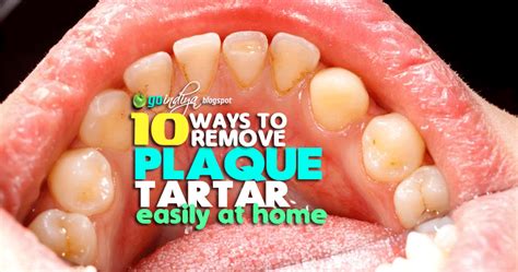 10 Easy Ways to Remove Plaque and Tartar from Teeth At Home Naturally ...