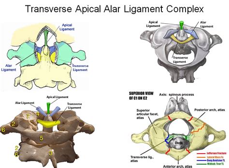 Atlantoaxial Instability - Spine - Orthobullets