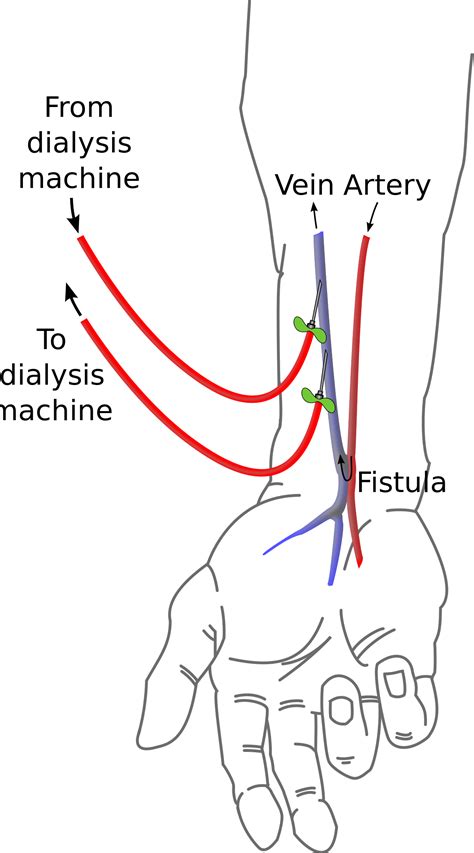 Cimino fistula - Wikipedia