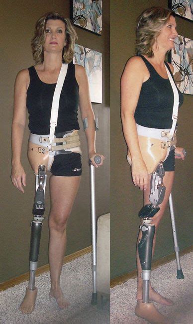 Pin by Scott Christiansen on Then and Know | Prosthetic leg, Amputee ...