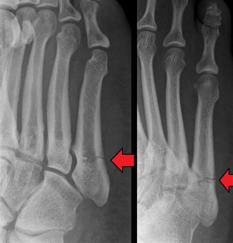 Jones fracture - Wikipedia