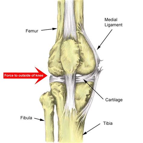 Medial Knee Ligament Sprain Treatment, Rehab & Exercises