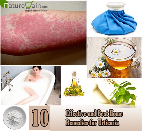 10 Effective and Best Home Remedies for Urticaria | Urticaria, Home ...