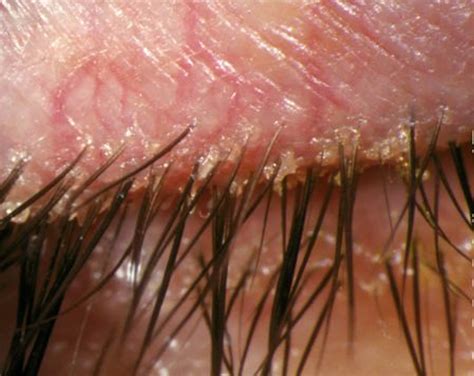 Blepharitis - Causes, Signs and Symptoms, Home Remedies & Treatment