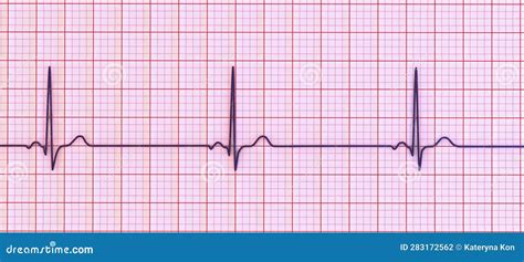 Electrocardiogram ECG Displaying Sinus Bradycardia, 3D Illustration ...