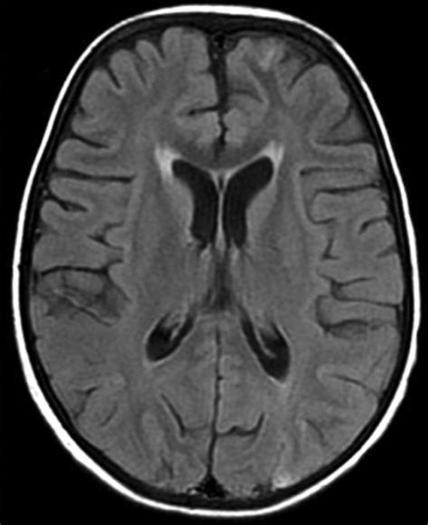 Normal Brain Mri Axial Flair