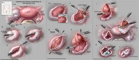 Laparoscopic Left Dermoid Ovarian Cystectomy Illustration by Keri Leigh ...