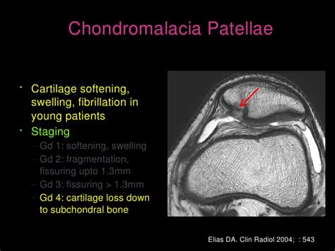 Appellate Court Orders Reduction in Pain and Suffering Awards for Knee ...