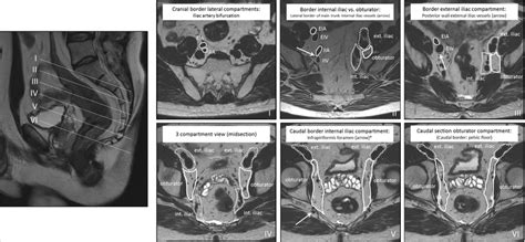 Anatomical boundaries of lateral lymph node stations (external iliac ...