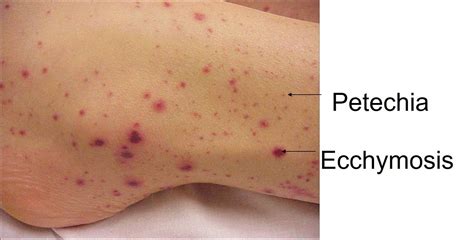 Ecchymosis Vs Petechiae