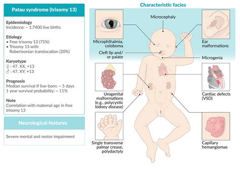 Trisomy 13 (Patau Syndrome): Symptoms, Causes Outlook, 51% OFF