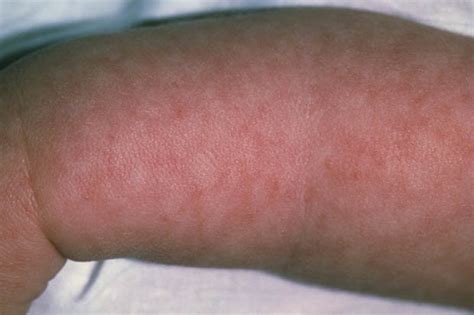 Meningitis rash: Symptoms of infection as toddler dies in UK after ...