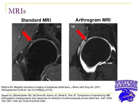 Labral Tear Hip Mri Images