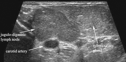 Ultrasound of Salivary Glands and the Non-endocrine Neck | Radiology Key