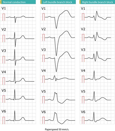 Left bundle branch block (LBBB): ECG criteria, causes, management ...