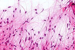 Pilocytic astrocytoma - Libre Pathology